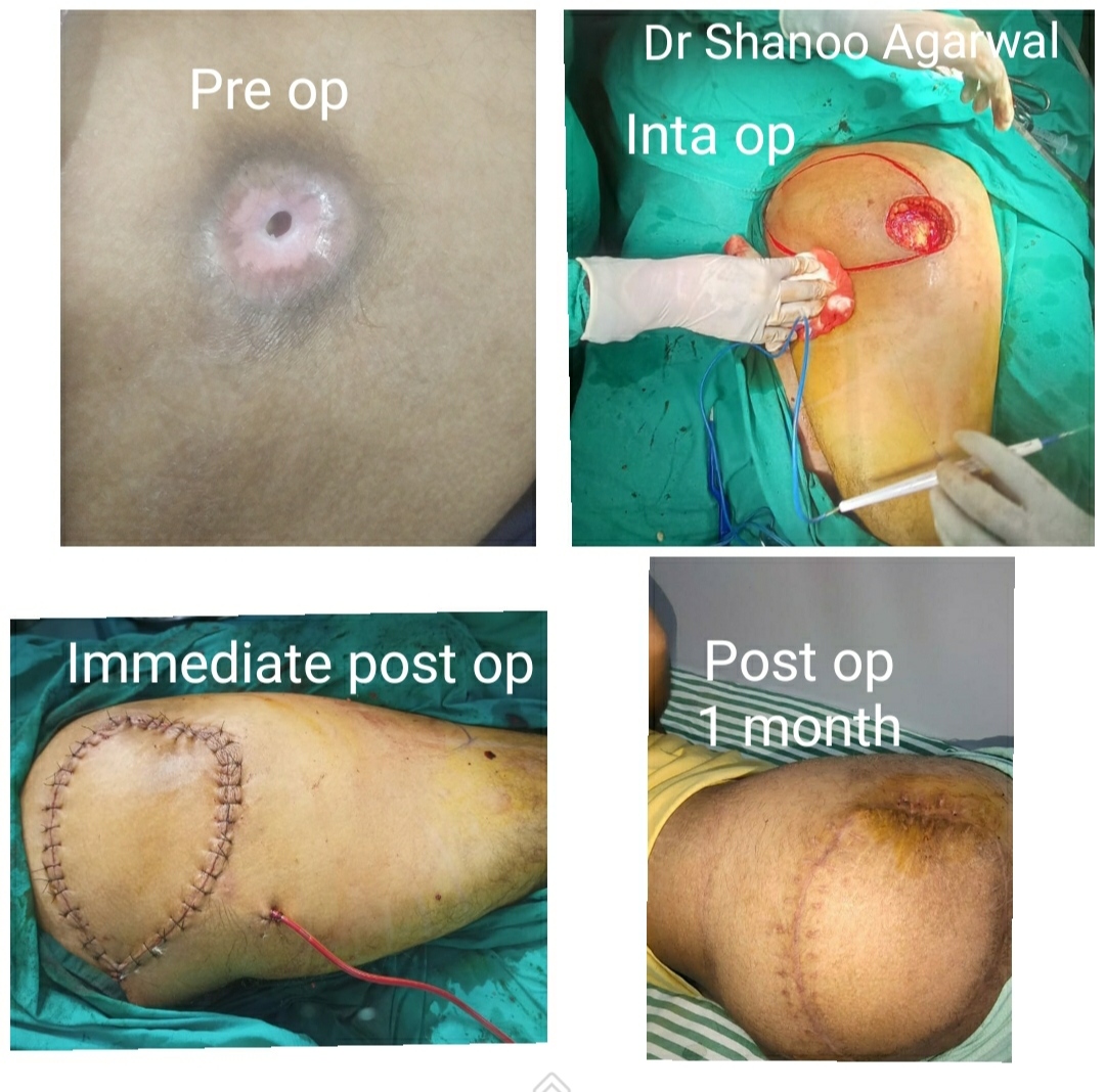 Bed Sore Surgery with SGAP Flap – Pre-op to 1-month post-op by Dr. Shanoo Agarwal