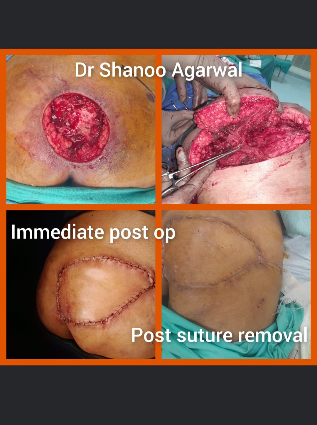 Bed Sore SGAP Flap Surgery Case 2 – by Dr. Shanoo Agarwal