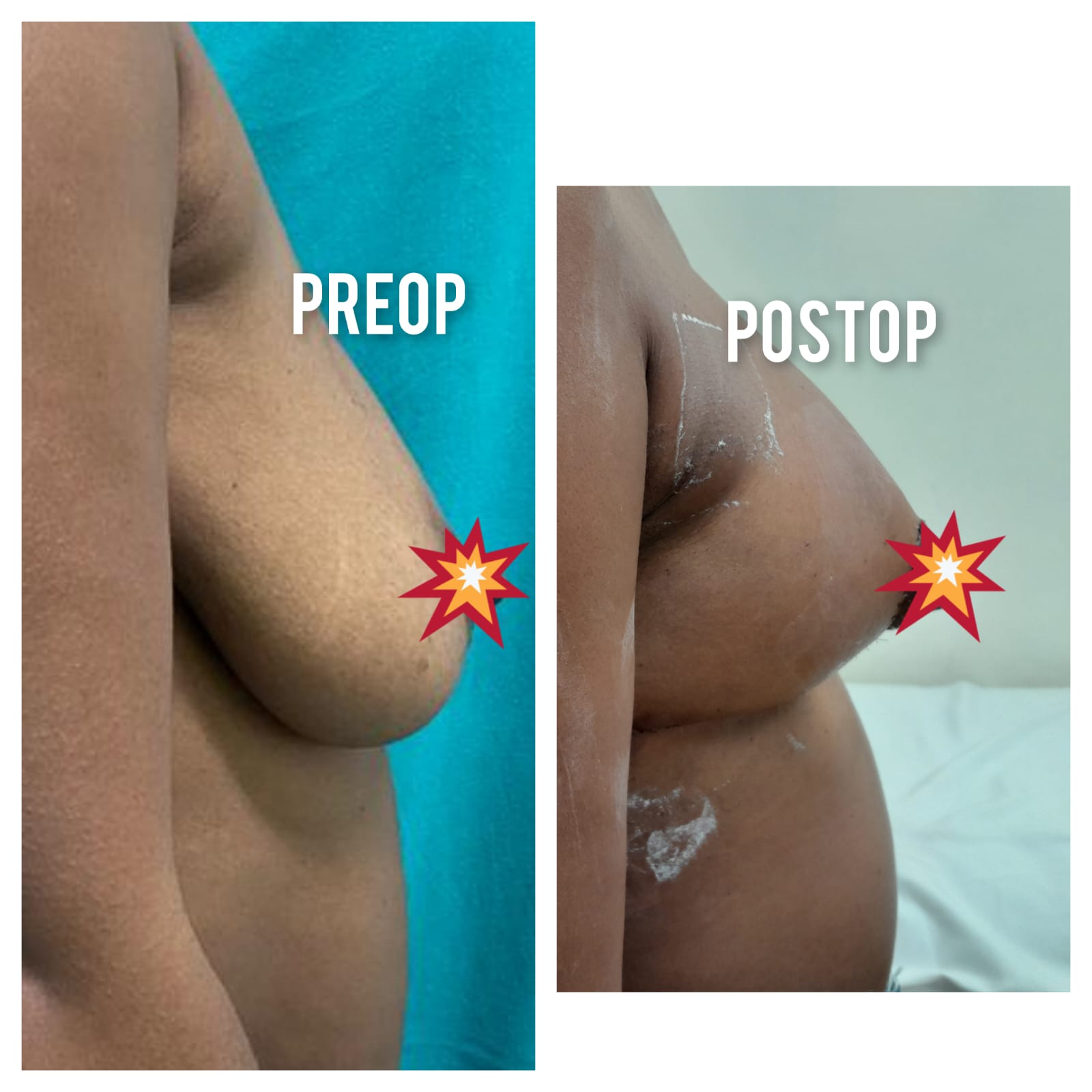 Breast Lift with Rewarding Results – Dr. Shanoo Agarwal