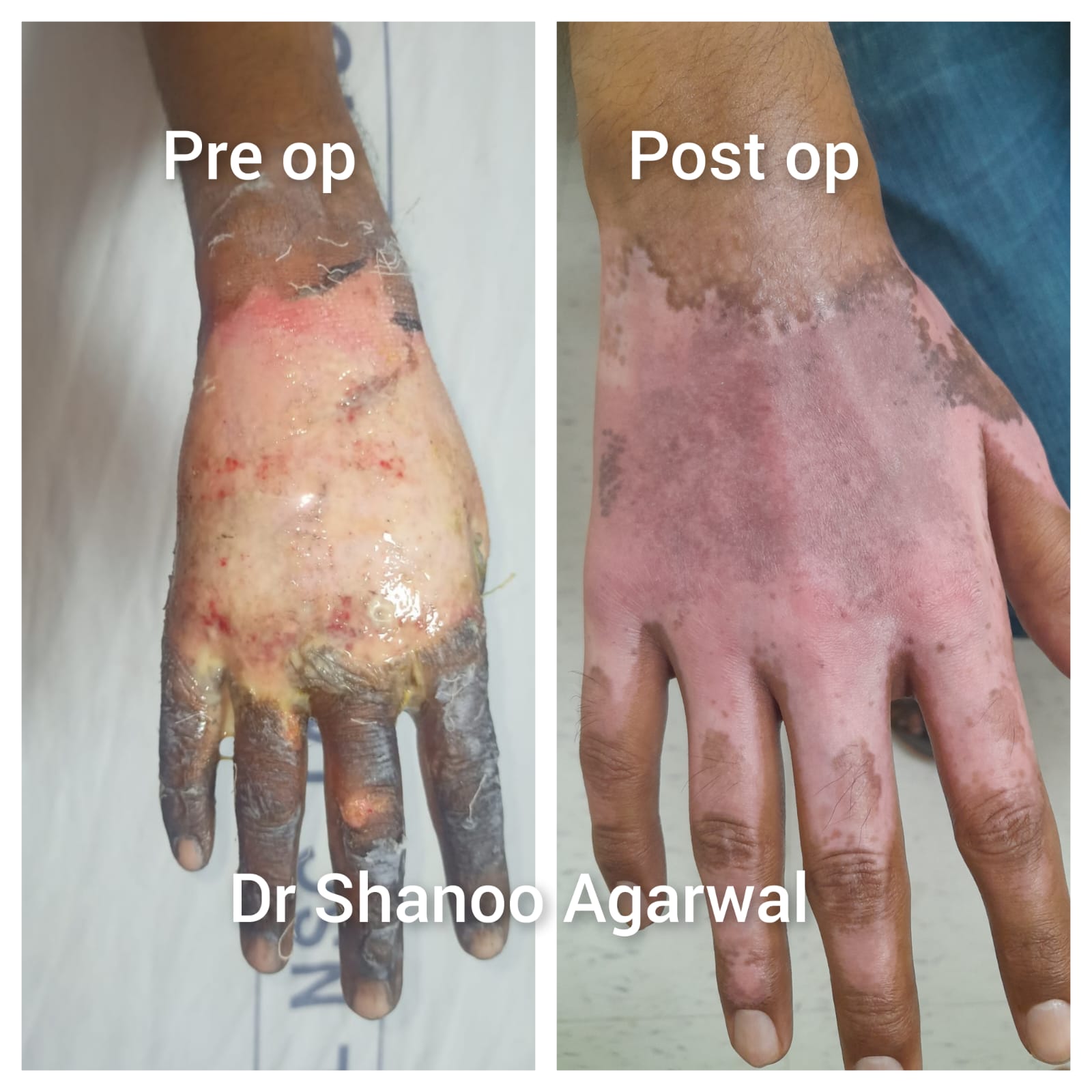 Burn Hand Full Functional Recovery – Dr. Shanoo Agarwal