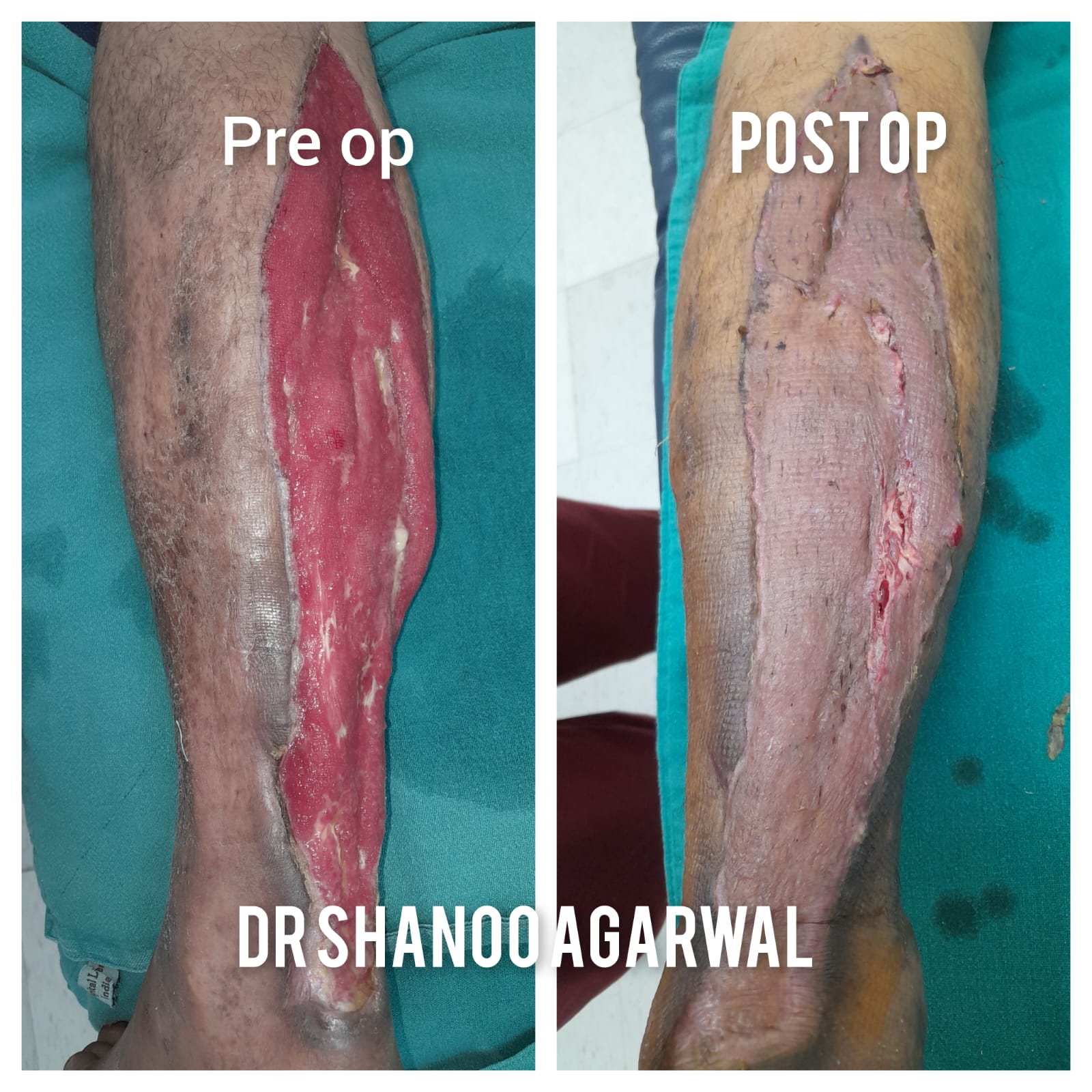 Diabetic Wound Reconstruction with Skin Graft 100% Take – Dr. Shanoo Agarwal