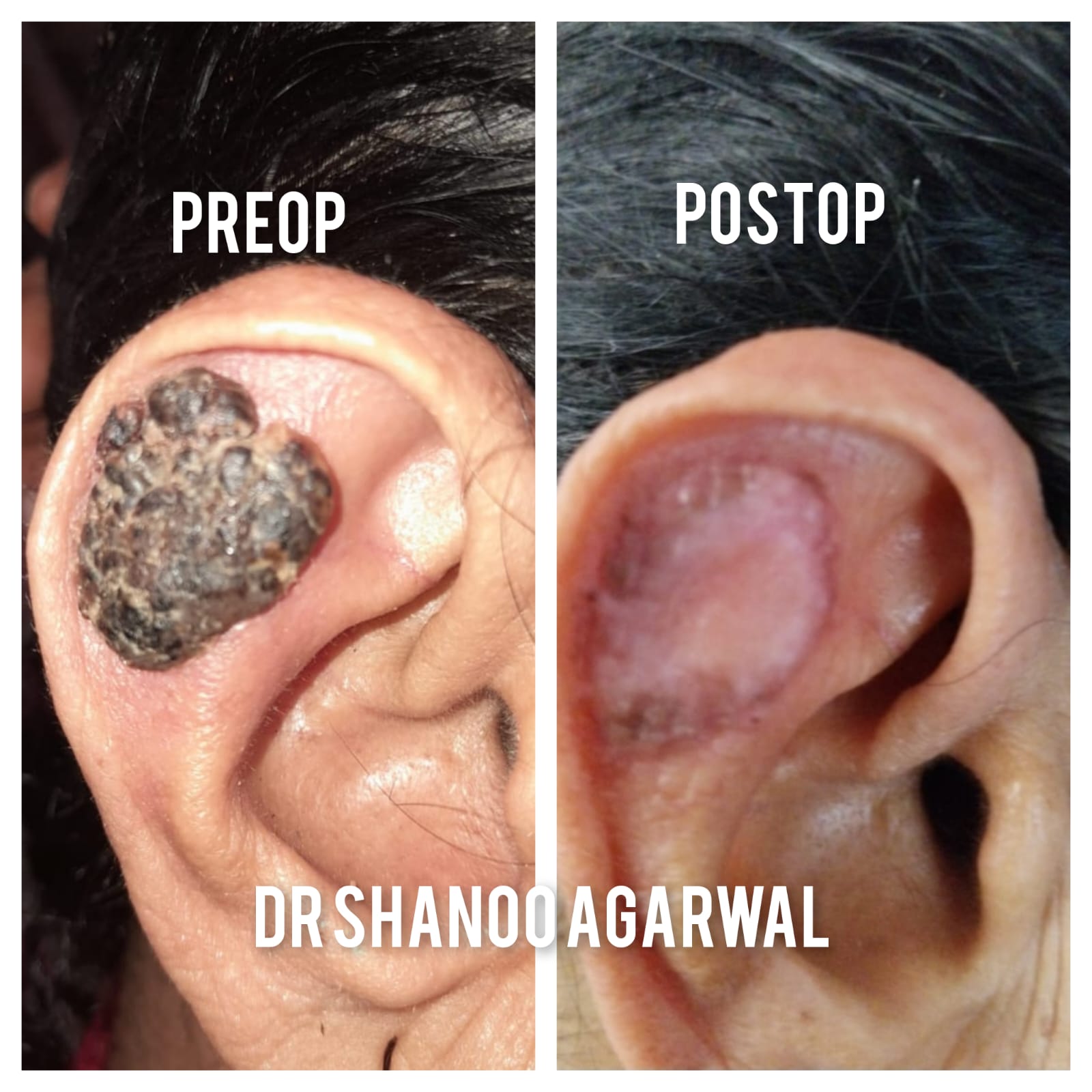 Ear Lesion Reconstruction with Full Thickness Graft – Dr. Shanoo Agarwal