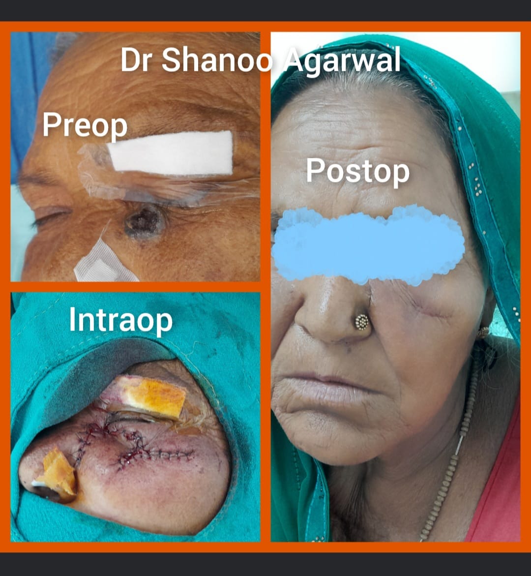 Eyelid Cancer Excision with Reconstruction – minimal scar – Dr. Shanoo Agarwal