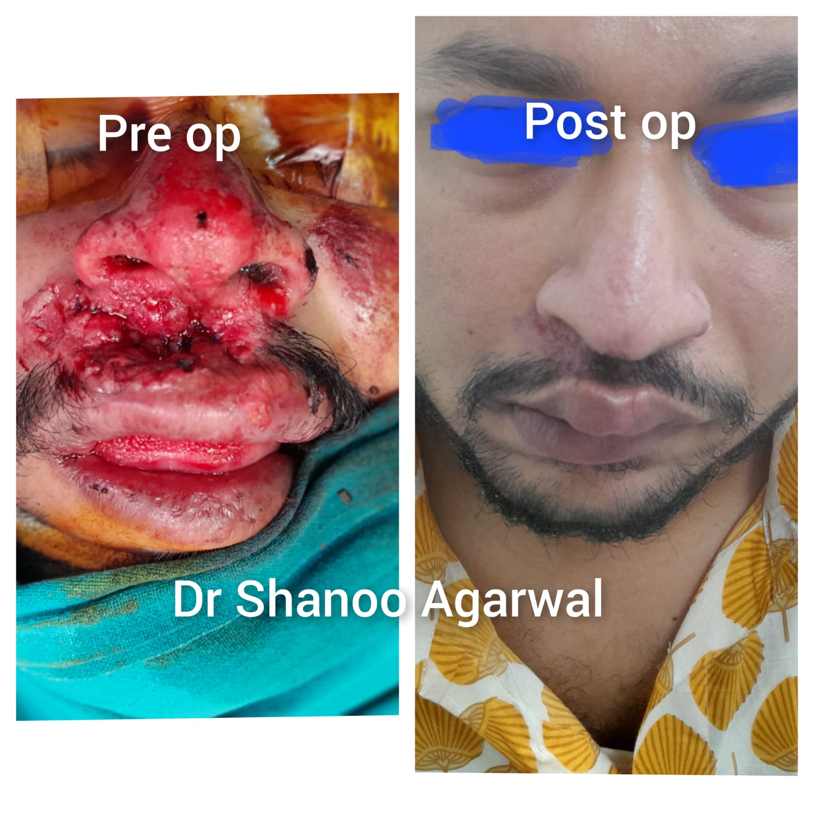 Severe Face Trauma Surgery – natural shape restored – Dr. Shanoo Agarwal