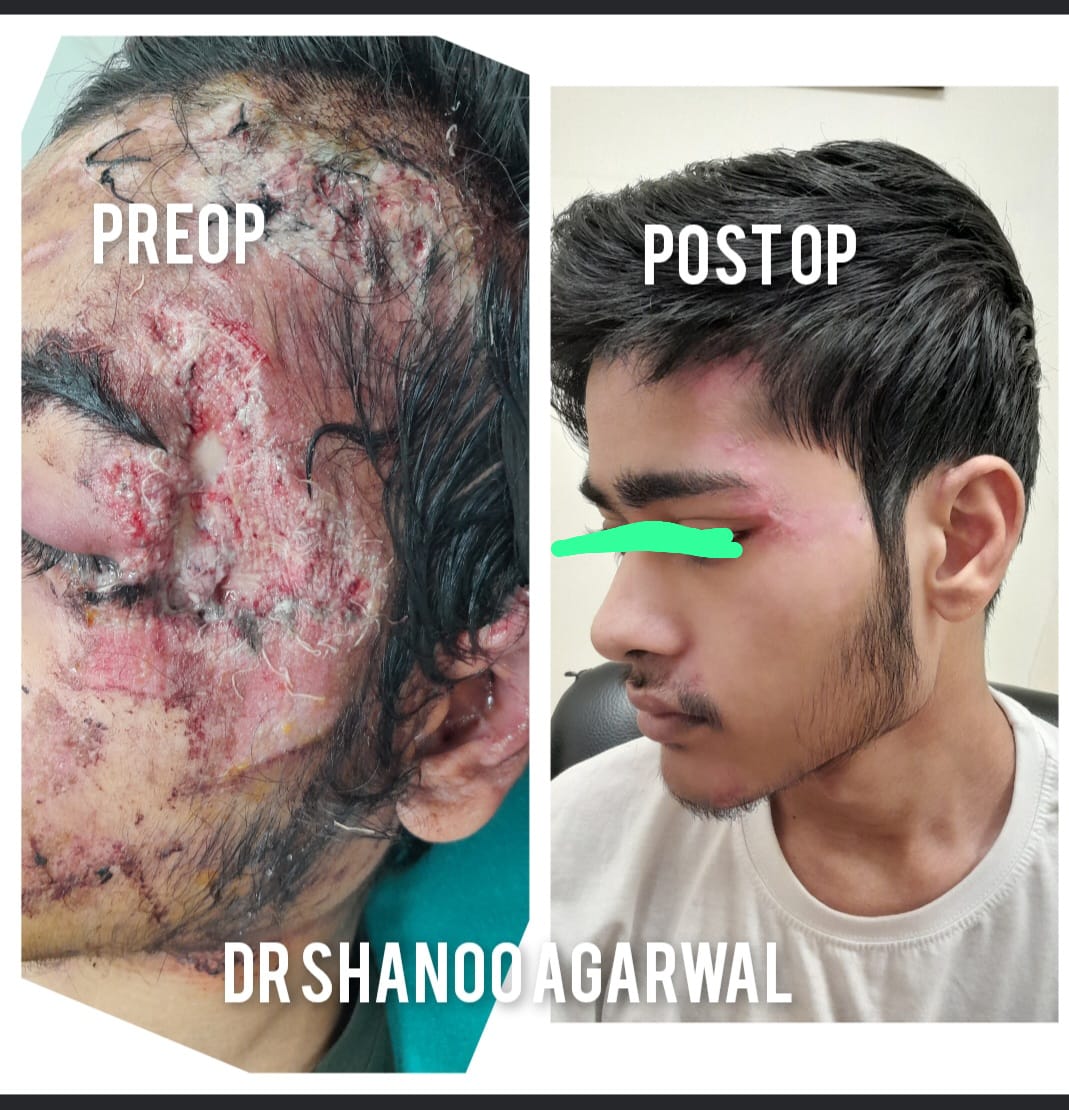 Face Traumatic Disfigurement Reconstruction – rewarding result – Dr. Shanoo Agarwal