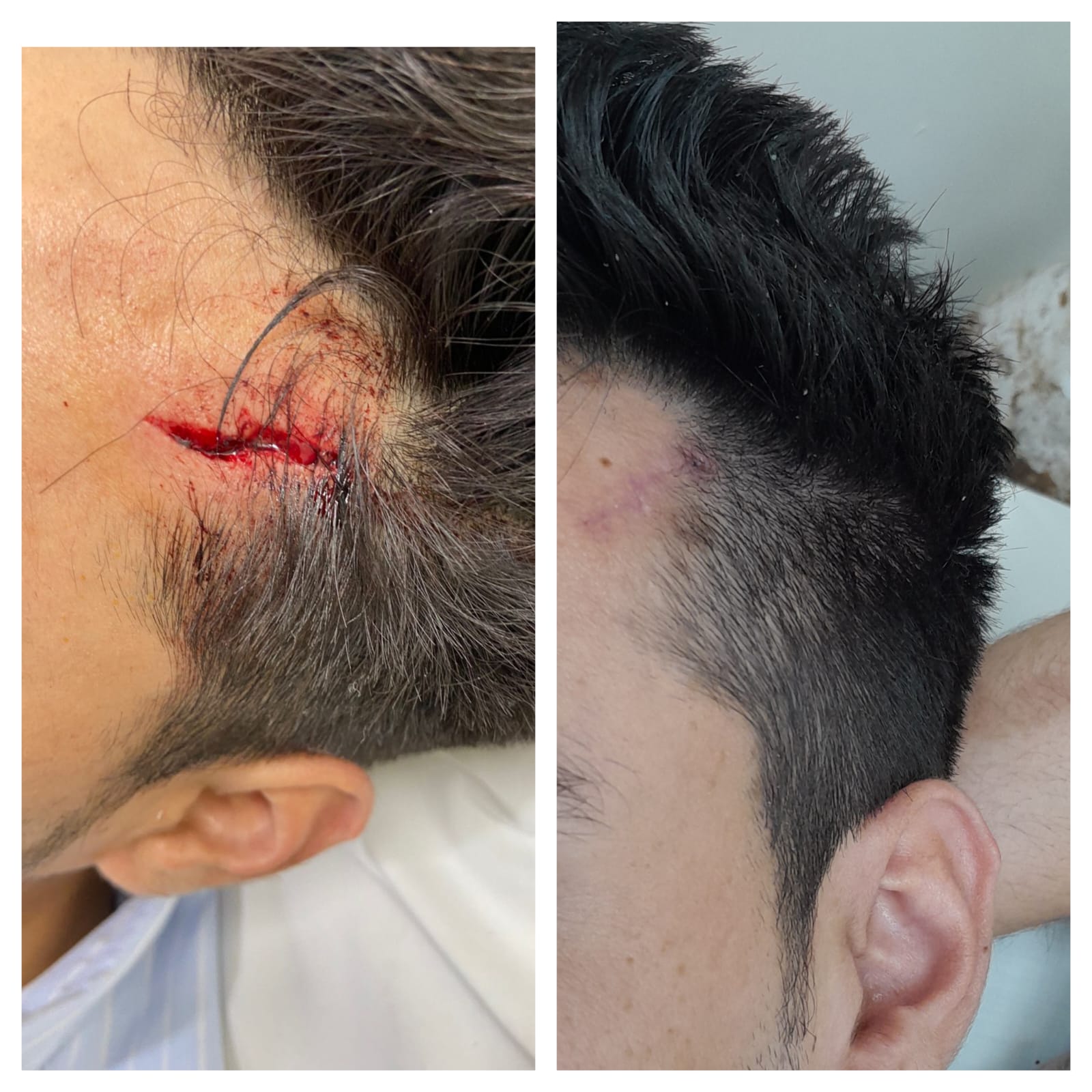 Lacerated Wound Repair with Minimal Scarring – Dr. Shanoo Agarwal