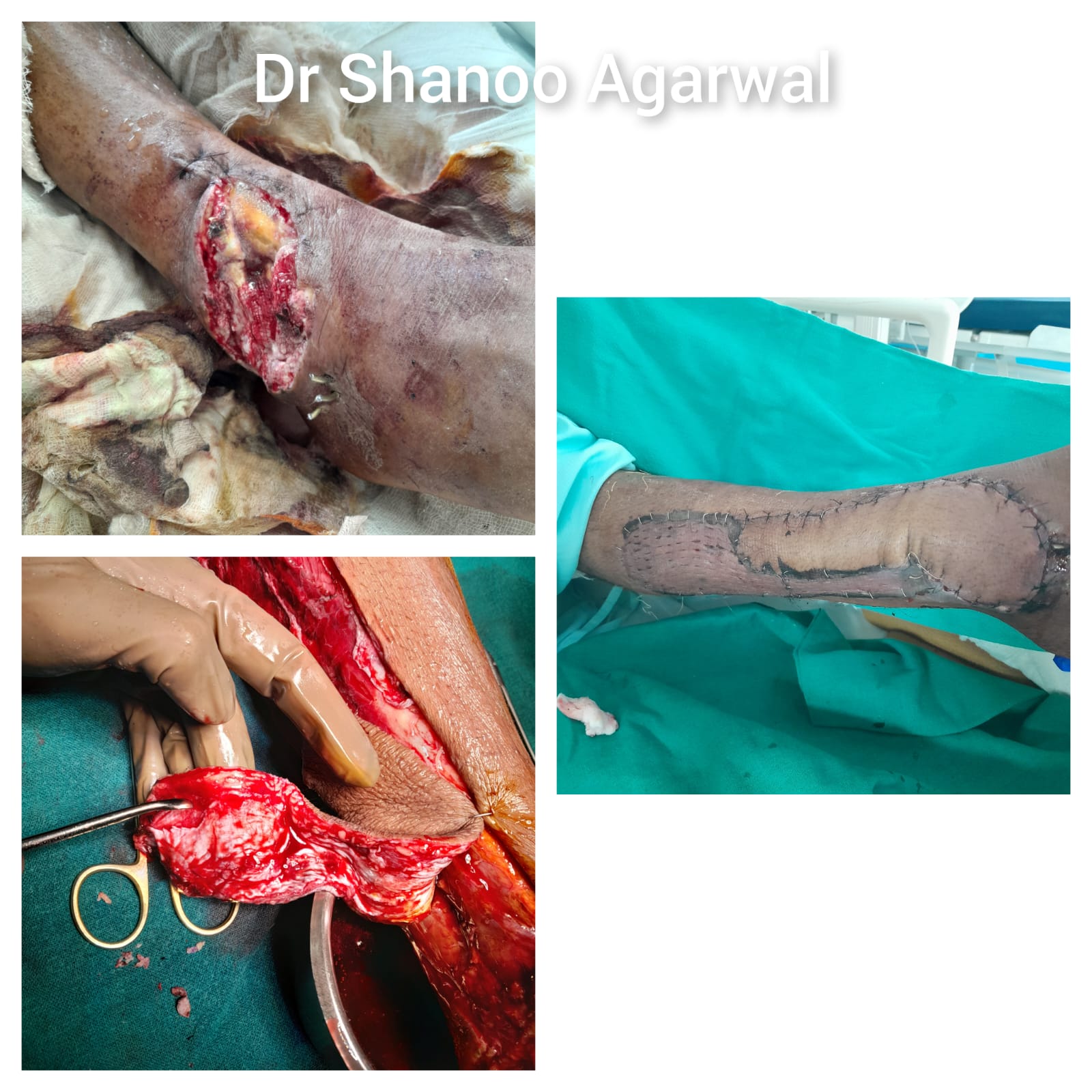 Leg Defect Reconstruction with Propeller Flap – Dr. Shanoo Agarwal