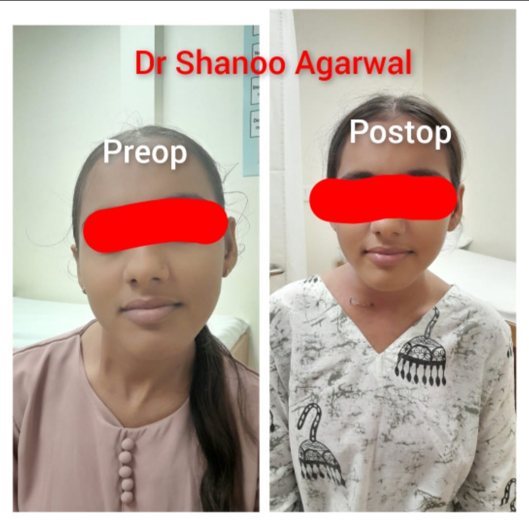 Torticollis Single-Stage Correction – 14-year-old patient – Dr. Shanoo Agarwal